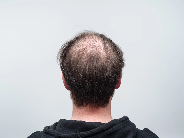 Mann mit lichtem Haar und Haarausfall am Hinterkopf